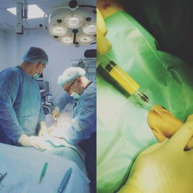 Làm dày dương vật có thể với sự trợ giúp của phẫu thuật
