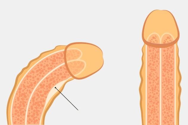 cách hiệu quả để làm thẳng dương vật