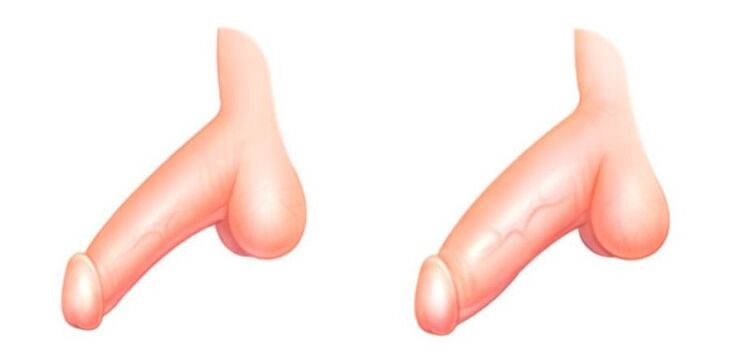 dương vật trước và sau khi mở rộng